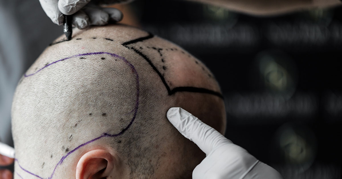 Androgenetische Alopezie Was Sind Die Häufigsten Arten Von Haarausfall?