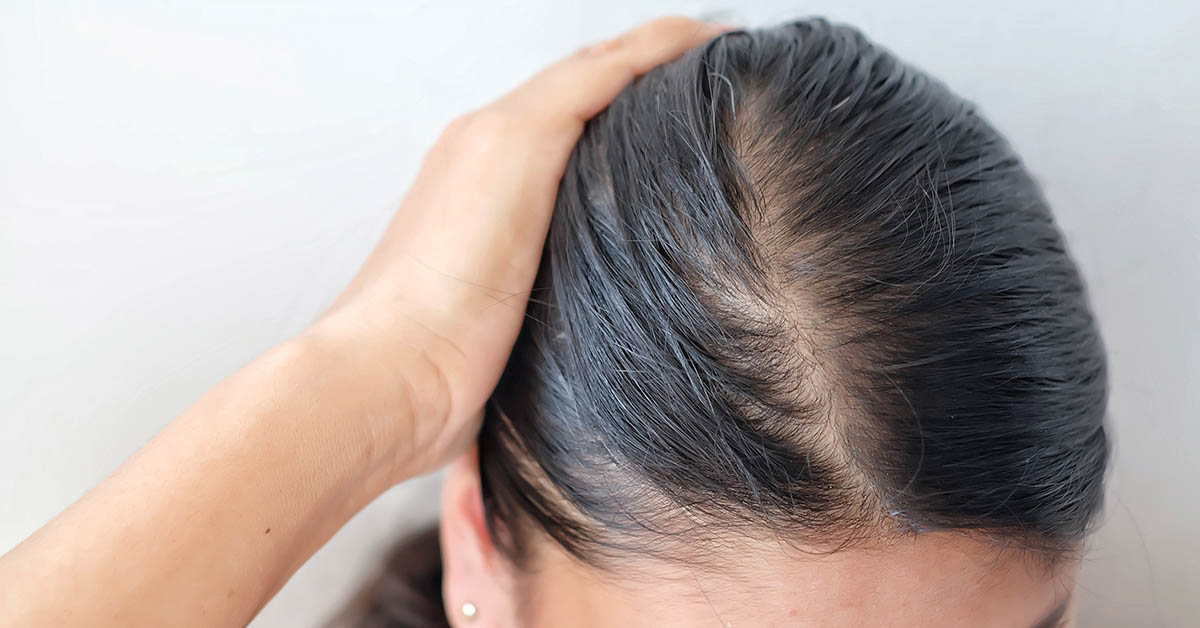 Haarausfall Bei Frauen: Ursachen Von Haarausfall Bei Frauen?