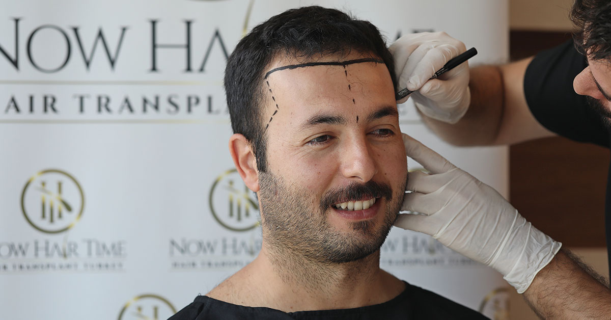 Wann Sollte Die Haartransplantation Durchgeführt Werden?