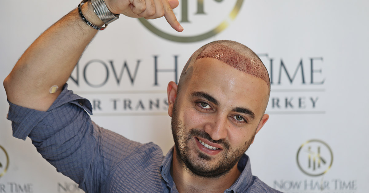 Wie Hoch Ist Der Preis Für Haartransplantation?